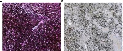 The immune checkpoint VISTA is associated with prognosis in patients with malignant uveal melanoma